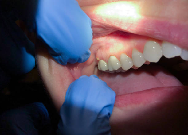 Best Emergency Root Canal Treatment in North Bellport, NY